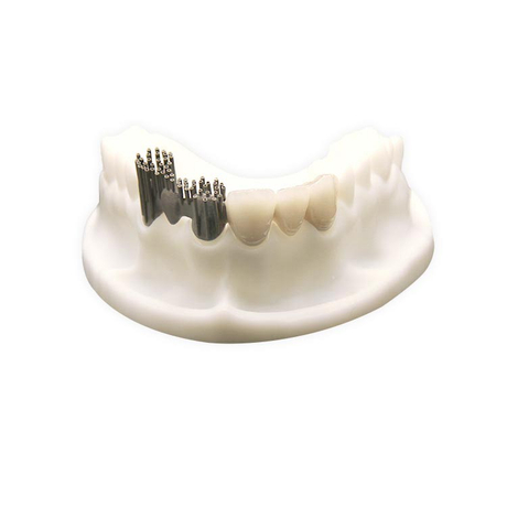 Porcelain-Fused-to-Metal (PFM) Crowns | Dental Lab Manufacturers ...